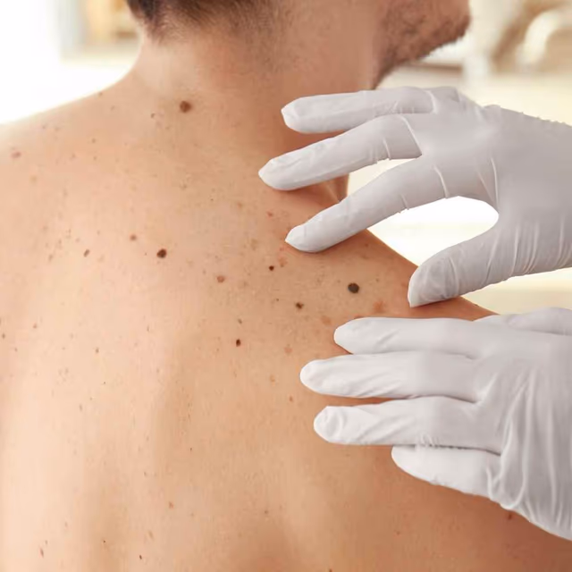Melanoma Monday