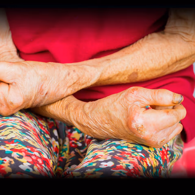 World Leprosy Day