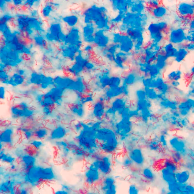 World Tuberculosis Day